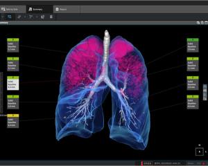 Coreline Soft Presents the Future of Integrated Thoracic Screening Expanded by AI Technology