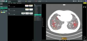 AI-based Integrated Lung and Cardiovascular Screening Era Begins: GC Green Cross i-Med Adopts Coreline Soft's AVIEW